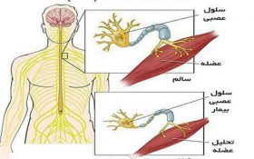 عوامل موثر بر بیماری ALS/بیماری‌های شایع مغز و اعصاب