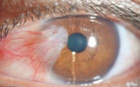 درمان تومورهای چشمی با روش پلاک تراپی در کشور