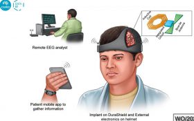 کلاه هوشمند از تشنج مغزی بعد از جراحی جلوگیری می‌کند
