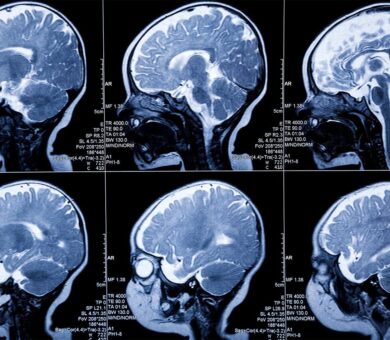شناسایی زودهنگام سرطان‌ مغز و پروستات با MRI نانویی