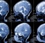 شناسایی زودهنگام سرطان‌ مغز و پروستات با MRI نانویی