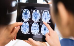 ارتباط سن بیولوژیکی بالا با خطر زوال عقل و سکته مغزی