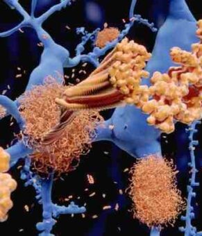 امید تازه برای درمان آلزایمر: بیماری در موش‌ها با نانوذرات کاملاً درمان شد