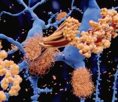 امید تازه برای درمان آلزایمر: بیماری در موش‌ها با نانوذرات کاملاً درمان شد